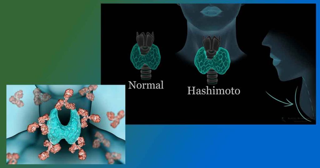 Как да вземем пенсия при Хашимото (ТЕЛК) и други болести.