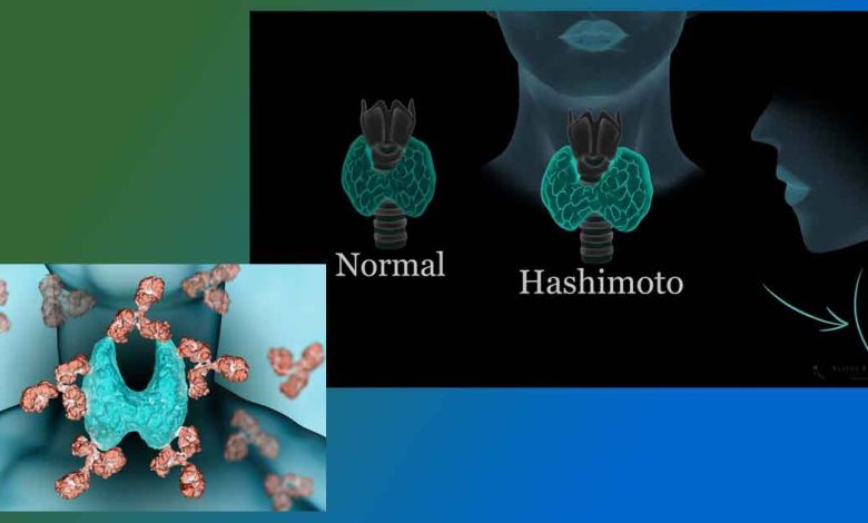 Как да вземем пенсия при Хашимото (ТЕЛК) и други болести.